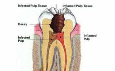 Root Canals - Dental Health Care Associates