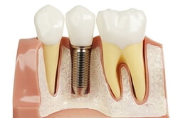 Dental Implant